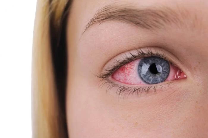 How Seasonal Allergies Cause Eye Discomfort and What You Can Do About It