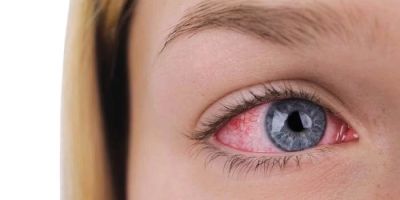 How Seasonal Allergies Cause Eye Discomfort and What You Can Do About It