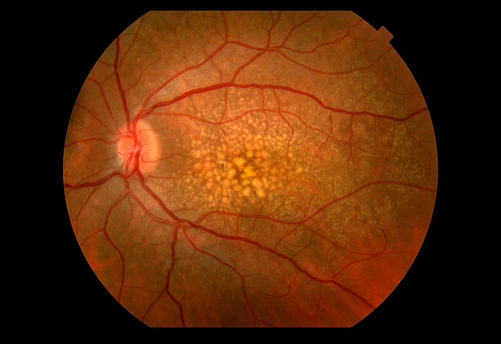Breakthroughs in Age-Related Macular Degeneration Research You Should Know
