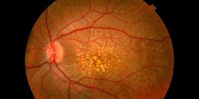 Breakthroughs in Age-Related Macular Degeneration Research You Should Know
