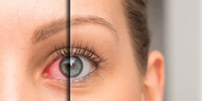 Best Ways to Relieve Eye Discomfort from Contact Lenses in the US