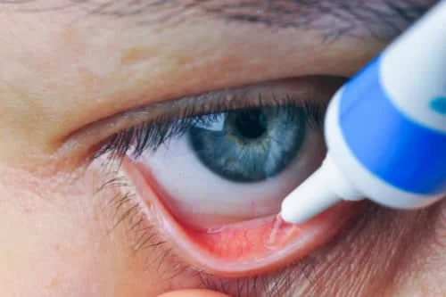 How to Manage Dry Eyes with Natural Remedies: Simple and Effective Solutions