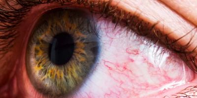 Discover Top Clinics for Effective Eye Allergy Treatment and Care