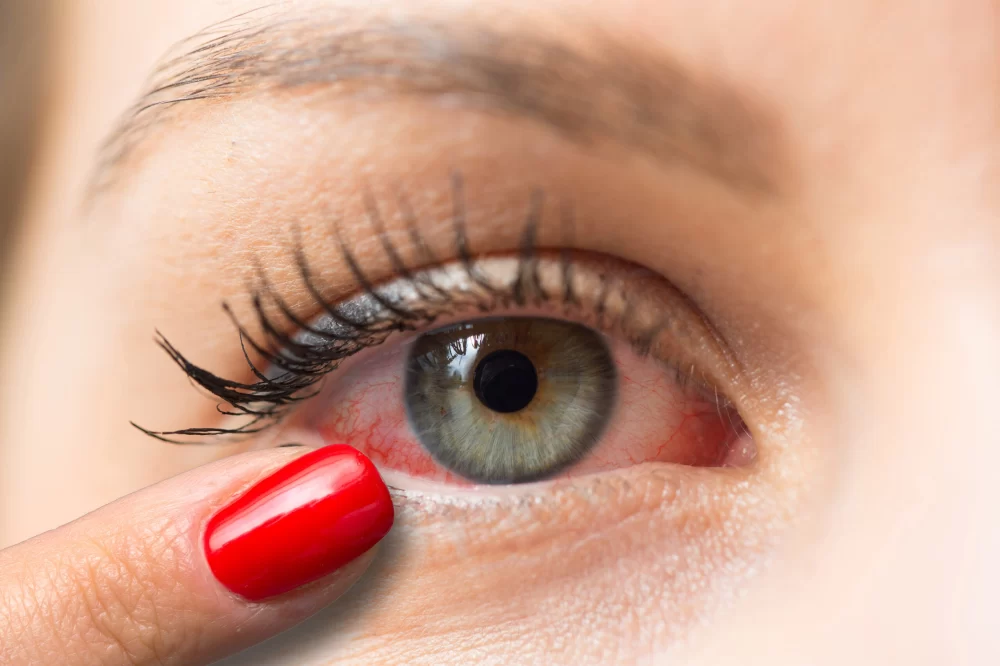 Effective Ways to Care for Eyes After an Eye Injury for Faster Recovery