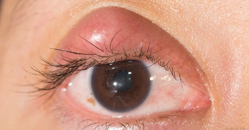 Best Ways to Treat Eye Styes at Home Safely and Effectively