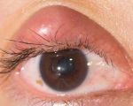 Best Ways to Treat Eye Styes at Home Safely and Effectively