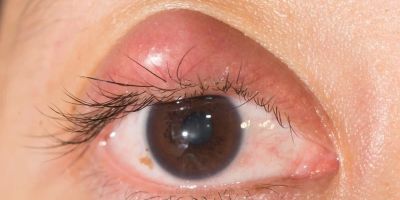 Best Ways to Treat Eye Styes at Home Safely and Effectively