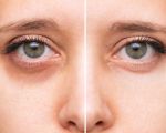 How to Treat Eye Dryness Caused by Screen Time: Tips and Solutions