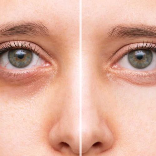 How to Treat Eye Dryness Caused by Screen Time: Tips and Solutions
