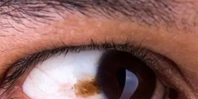 How to Recognize Early Symptoms of Eye Melanoma and Seek Timely Treatment