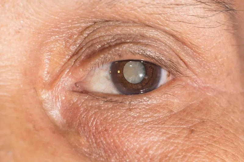 Symptoms of Cataracts and When to See a Doctor for Eye Health