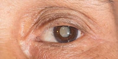 Symptoms of Cataracts and When to See a Doctor for Eye Health