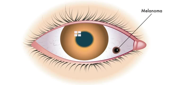 How to Recognize Symptoms of Eye Melanoma Early and Protect Your Vision