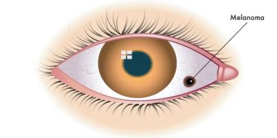 How to Recognize Symptoms of Eye Melanoma Early and Protect Your Vision