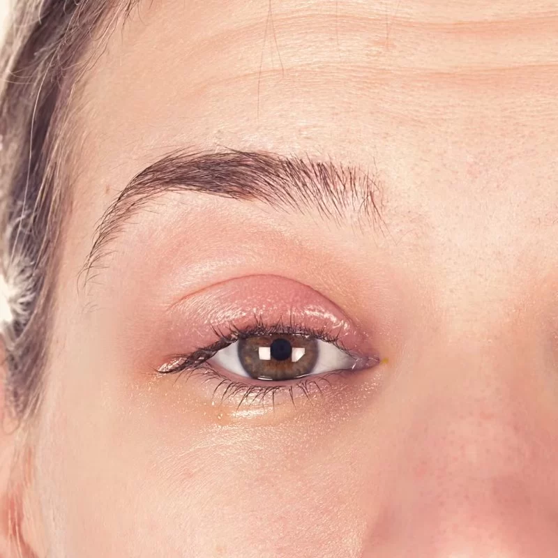 How to Treat Eye Redness and Itching with Natural Remedies | Eye Docs Guide