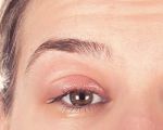 How to Treat Eye Redness and Itching with Natural Remedies | Eye Docs Guide